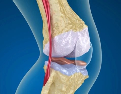 Cartilage, illustrated